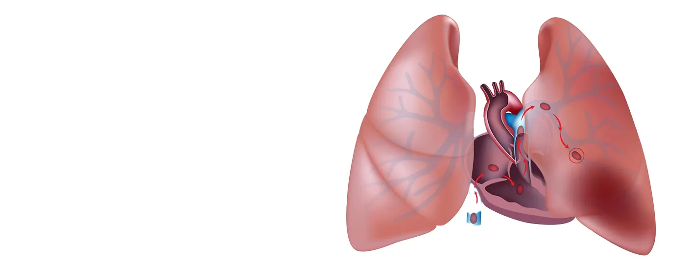 Thromboembolic Disorders: Early Signs, Complications, and Treatment Options